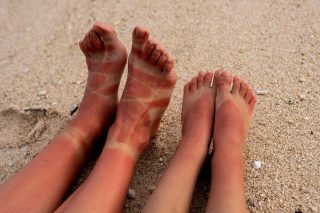 Cómo evitar las quemaduras por el sol en los pies durante el verano